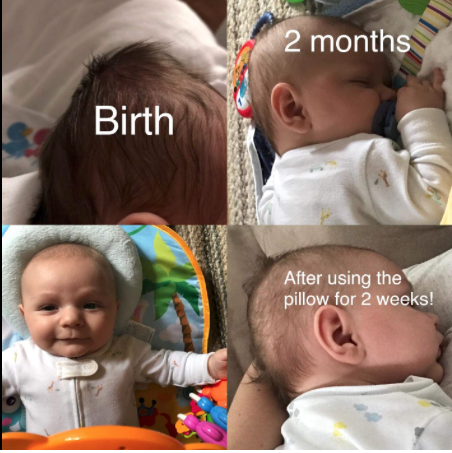 2 month old with flat head
